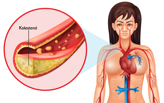 Hvis der føres mere kolesterol rundt i kroppen end cellerne har brug for sætter det sig som åreforkalkning i blodkarrenes vægge.
