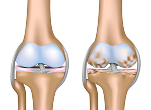 Til venstre et normalt knær og til højre et knæ med slidgigt, hvor brusken er forsvundet og knoglerne slider direkte på hinanden.